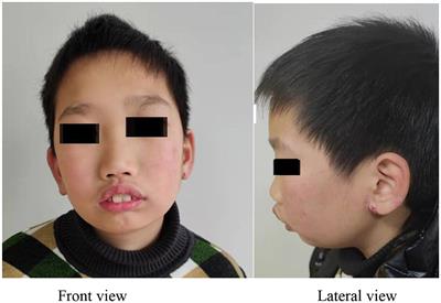 Case Report: Long-Term Treatment and Follow-Up of Kleefstra Syndrome-2